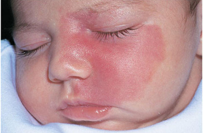 Капиллярная гемангиома