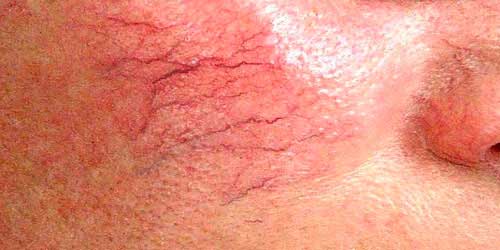 капилляры на щеках