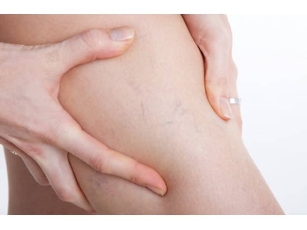 капилляры на ноге