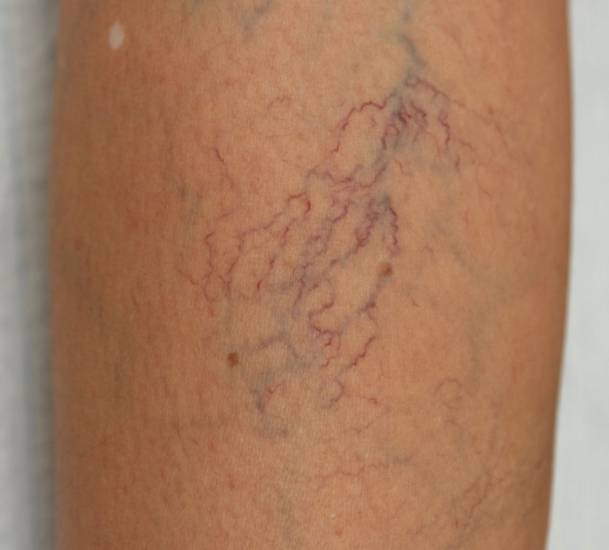 капиллярная сетка