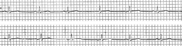 кардиограмма