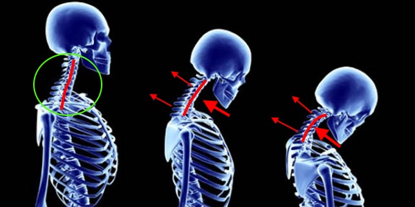 При шейном кифозе лордоз в этой области начинает выпрямляться