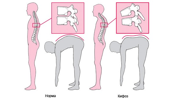 Патологический кифоз диагностируют при угле искривления более 30 градусов