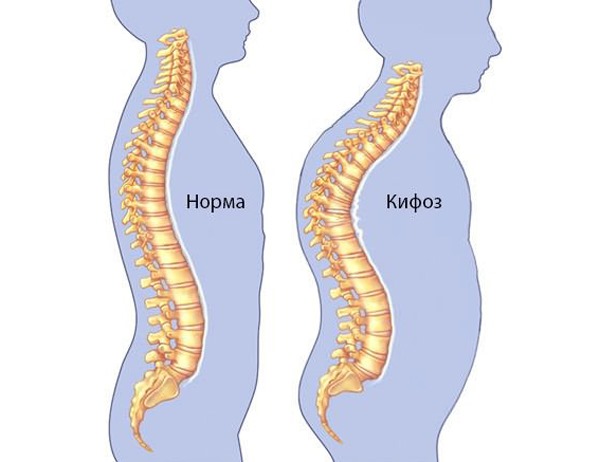 Кифоз может быть компенсированный и некомпенсированный