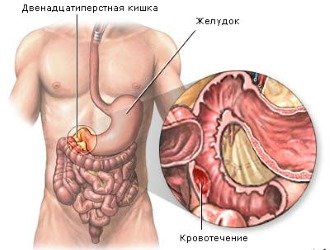 При приеме НПВС могут появляться кровотечения в ЖКТ