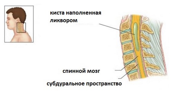 Периневральная киста позвоночника заполнена ликвором