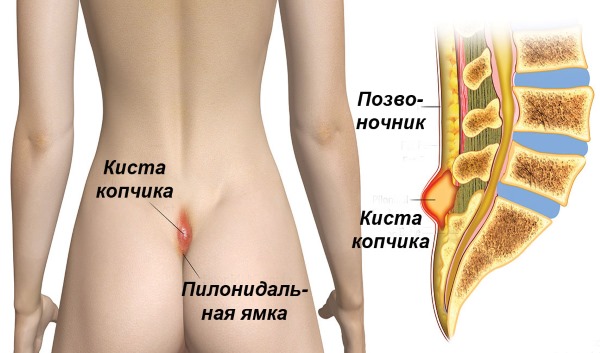 Копчиковый свищ (копчиковая киста) возникает у людей ведущих малоподвижный образ жизни