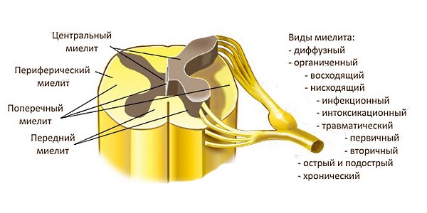 Миелит можно классифицировать в зависимости от того, какая именно часть мозга воспаленая