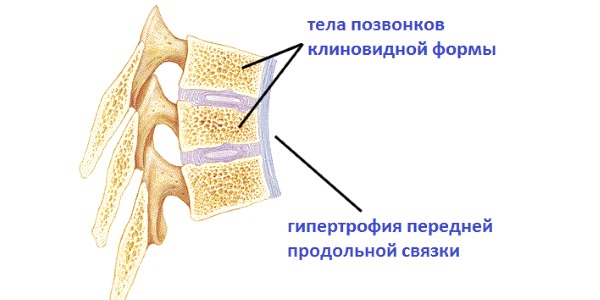 Клиновидная деформация позвонков может быть активной и неактивной