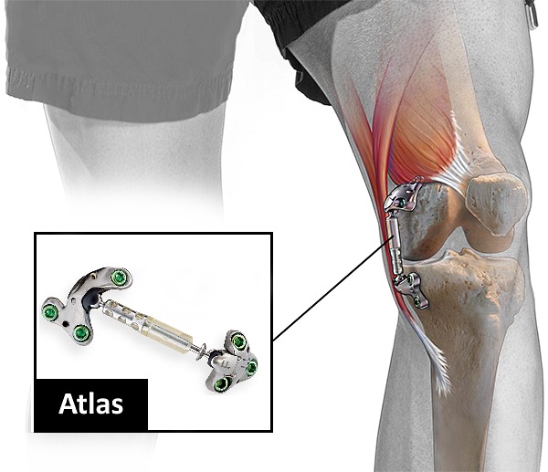 Новый имплант снимает 13 кг нагрузки с больного сустава