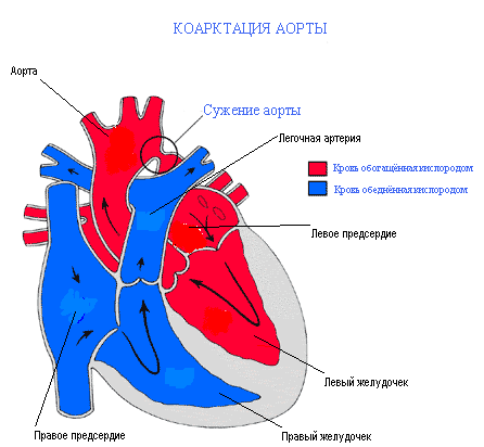 Коарктация аорты