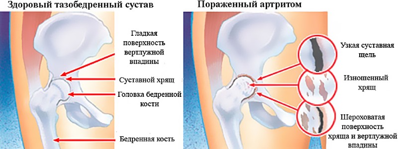 Чаще всего назначают Диклоберл Ретард при суставных заболеваниях