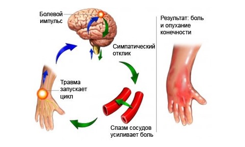 Трамадол используют при сильных болевых синдромах различного происхождения