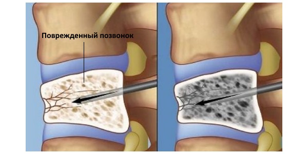 Компрессионный перелом позвоночника возникает из-за сильного давления на него