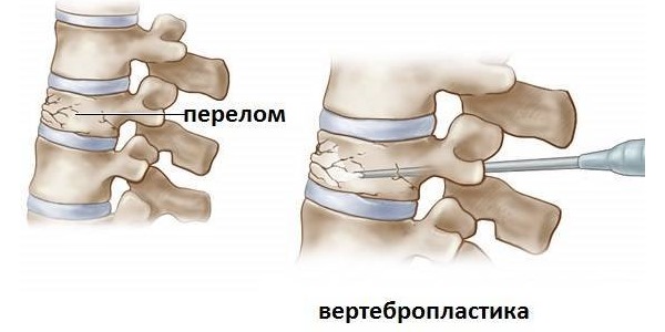Вертебропластика делается для укрепления поврежденного позвонка с помощью специального цемента