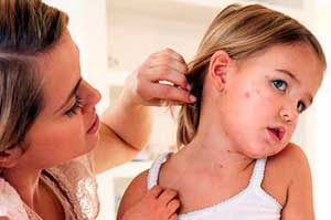 корь у детей