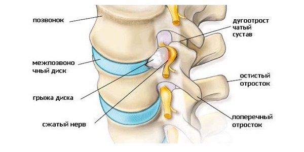 Бенальгин хорошо справляется с корешковыми синдромами