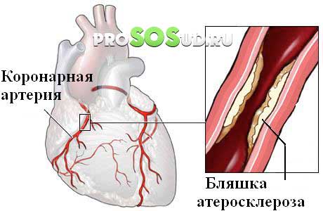 коронарный атеросклероз