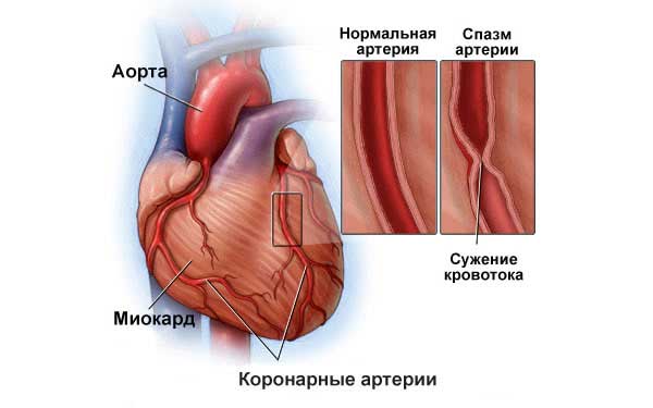 коронарный спазм
