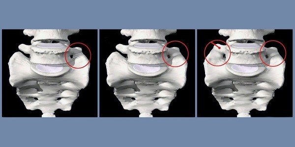 Для диагностики сакрализации необходимо сделать рентгеновский снимок