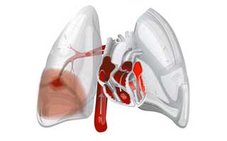 кровь в легких