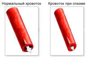 кровоток при спазме сосудов