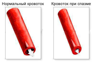 кровоток в нормальном и суженом сосуде