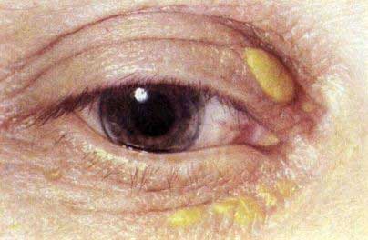 бляшки на веках