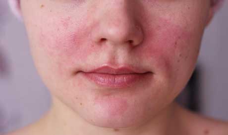 купероз на лице