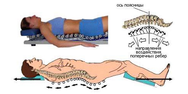 Вытяжение позвоночника производится за счет собственного веса пациента