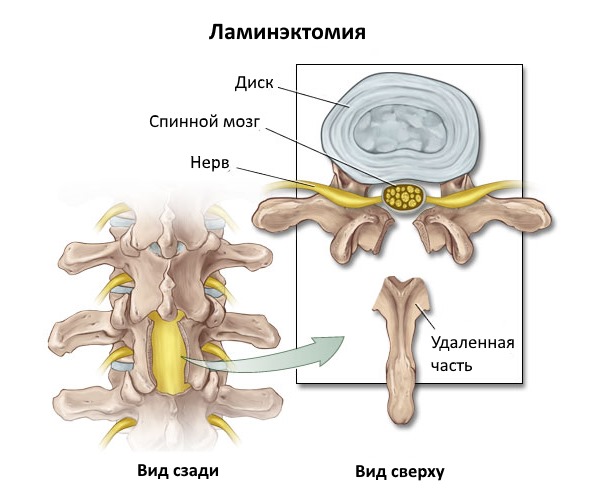 Ламинэктомия выполняется крайне редко