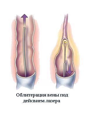 действие лазера на вену