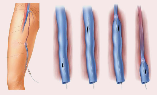 лазерная коагуляция вен