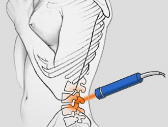 Для лечения грыжи позвоночника лазером используют инфракрасное излучение