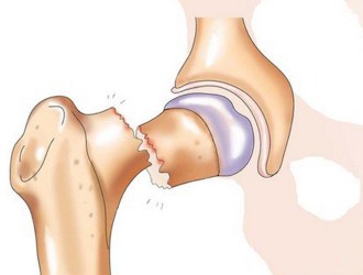 Запрещено принимать бисфосфонат при атипичном переломе бедренной кости