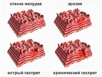 При кровотечениях в ЖКТ запрещено использовать противовоспалительный препарат