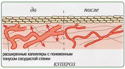 лечение купероза, до и после