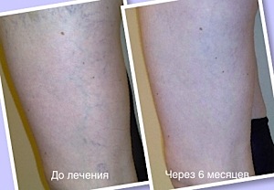 До и после процедуры лечения варикоза