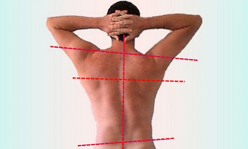 Диагностировать 1 степень сколиоза можно по асимметричному размещению лопаток