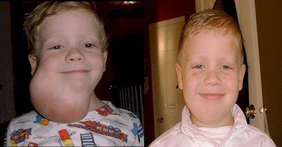 Лимфангиомы