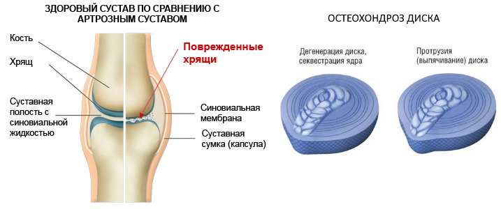 Хондролон назначают для укрепления хрящей в суставах и межпозвонковых дисках