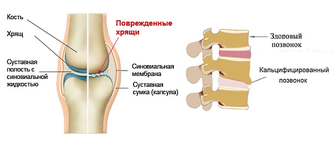 Болевой синдром в суставах и мышцах - показания для использования Адвила