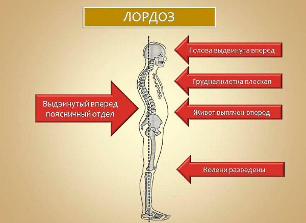 Обратите внимание на клиническую картину при лордозе