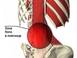 Основной симптом люмбаго - острая боль в пояснице