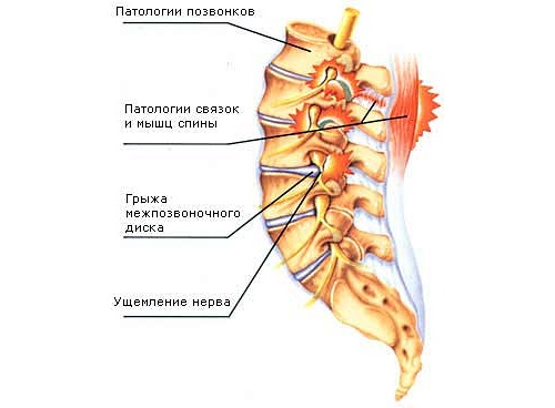 Использовать Бом-Бенге можно при различных болевых синдромах в спине и суставах