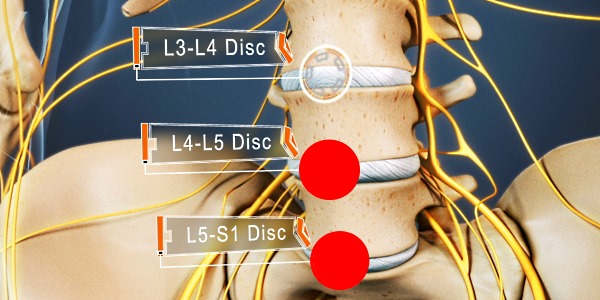 Чаще всего грыжа поражает два диска, находящихся в поясничном отделе