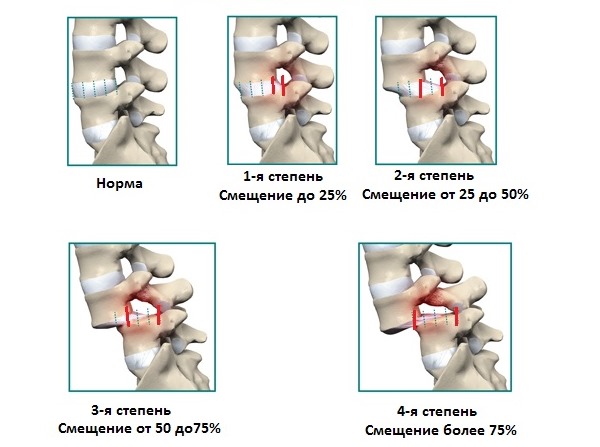 Часто фиксацию позвоночника проводят при смещении позвонков