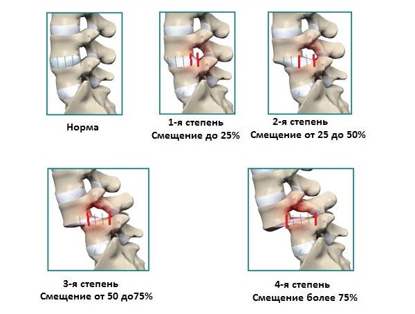 Выделяют четыре стадии смещения позвонков