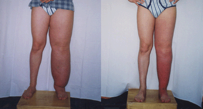 степень заболевания