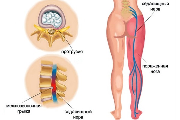 Назначают Мотрин при невралгии, артралгии и миалгии